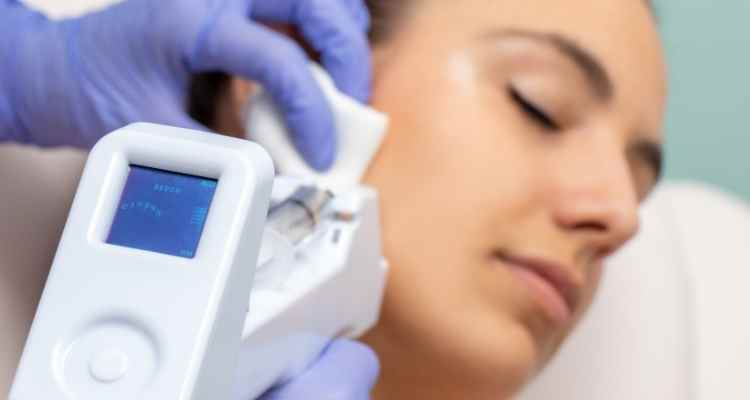 How Can Micro Needling Help with Acne Scars