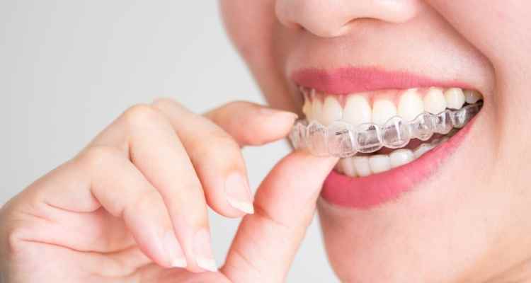 7 Awesome Benefits of Invisalign