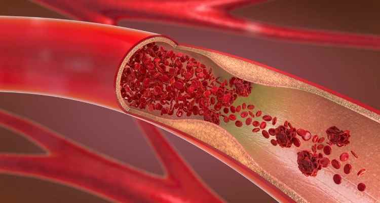 Arterial and Venous Conditions Interferes With Effective Blood Circulation