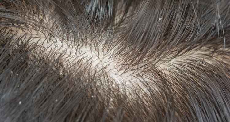 How to Get Rid of Dandruff Using Scalp Treatment