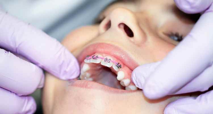 How to Get the Best Monthly Prices for Braces