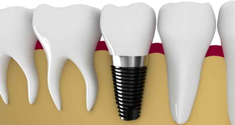 Managing Your Dental Implants