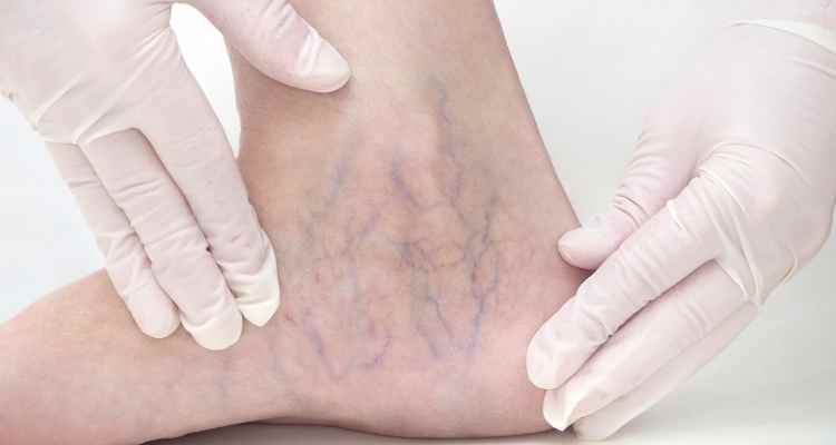 Say Goodbye to Leg Pain with Sclerotherapy Treatment