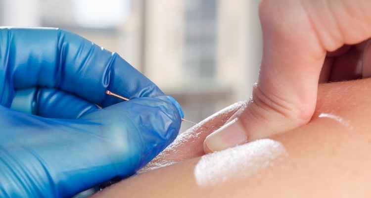 Pros & Cons of Dry Needling