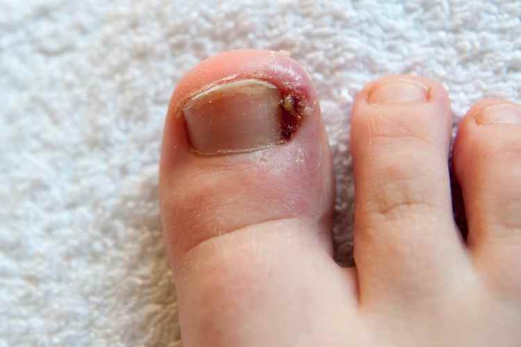 Ingrown Toenail