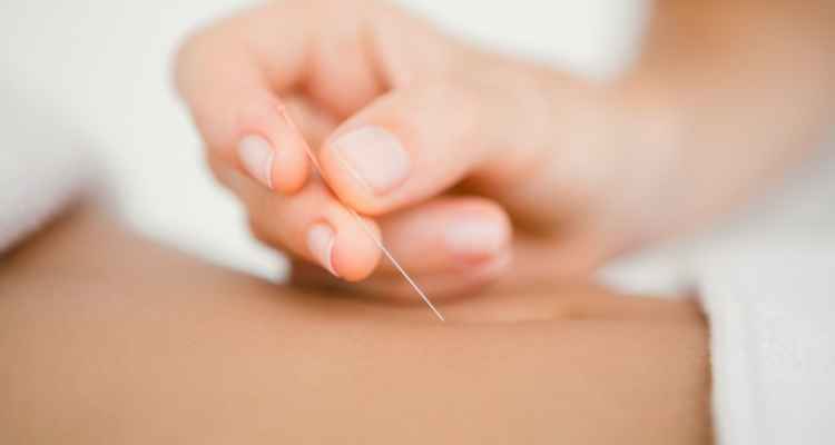 The Ultimate Guide to Understanding Acupuncture