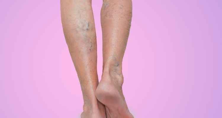 Varicose Veins