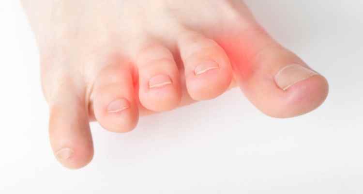 How To Treat Neuroma At Home