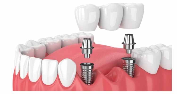 How To Choose The Best Dentist For Dental Implants