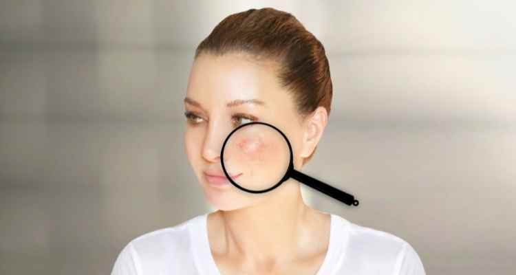 Everything You Need To Know About Rosacea 