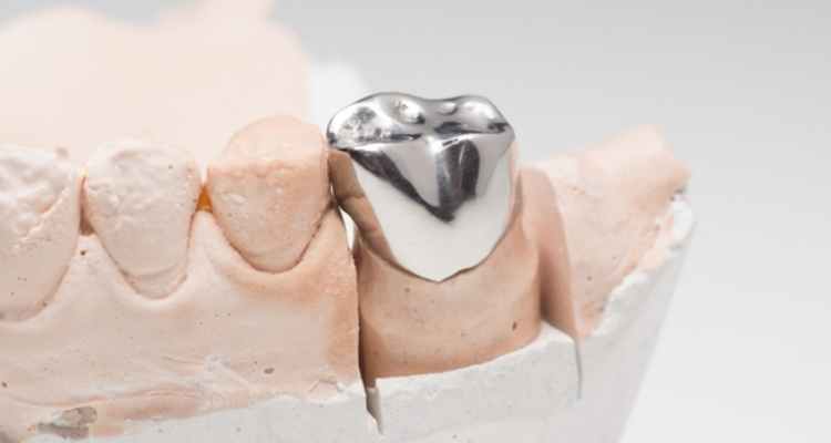 What to Do If Your Dental Crown Falls Off
