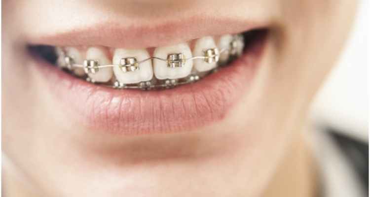 Living With Braces: What To Do and What Not To Do