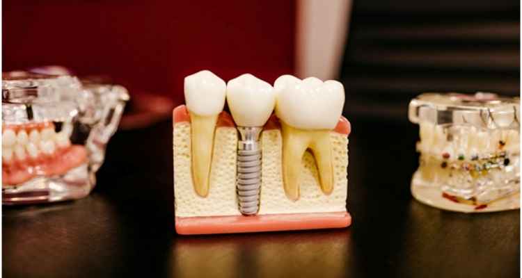 What Are the Benefits of Affordable Dental Implants