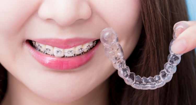 The Pros and Cons of Getting Mouth Braces
