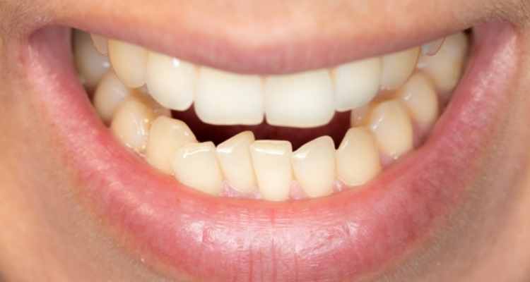 7 Types of Malocclusion and How to Treat Them