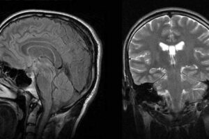 NARCOLEPSY BRAIN AND NORMAL BRAIN