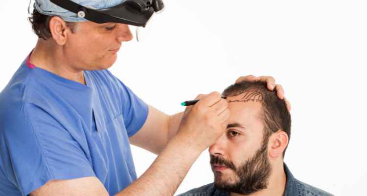 FUE Hair Transplant: Key Benefits to Consider