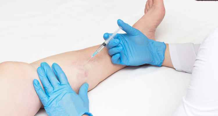 Sclerotherapy: Before, during, and after a session
