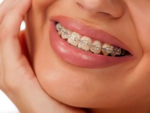 What are Bite Blocks For Braces And How Do They Help Braces