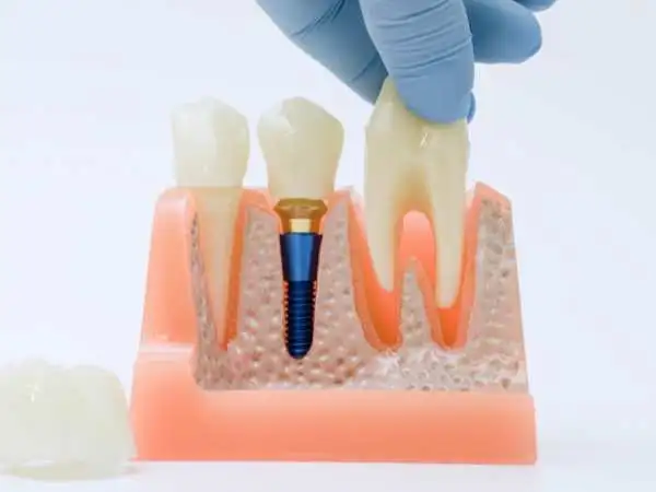Molar Extraction Cost What It Really Costs to Remove a Molar Tooth and Why Prices Jump